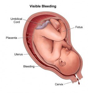 Bleeding During Pregnancy